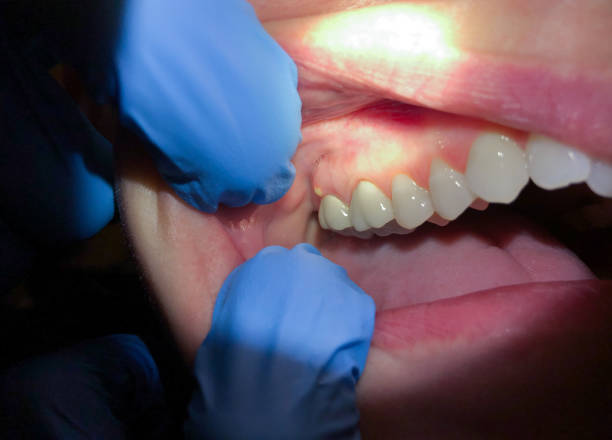 Best Emergency Dental Care for Broken or Chipped Teeth in Walnut Grove, CA